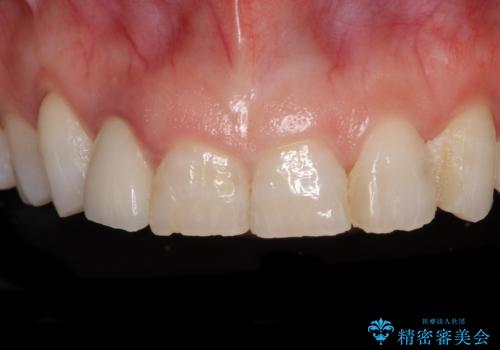 歯肉が腫れている前歯　外科処置を併用したオールセラミッククラウンの症例 治療前
