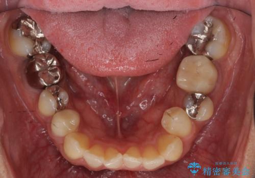 虫歯がひどく抜歯 奥歯をブリッジにの治療前