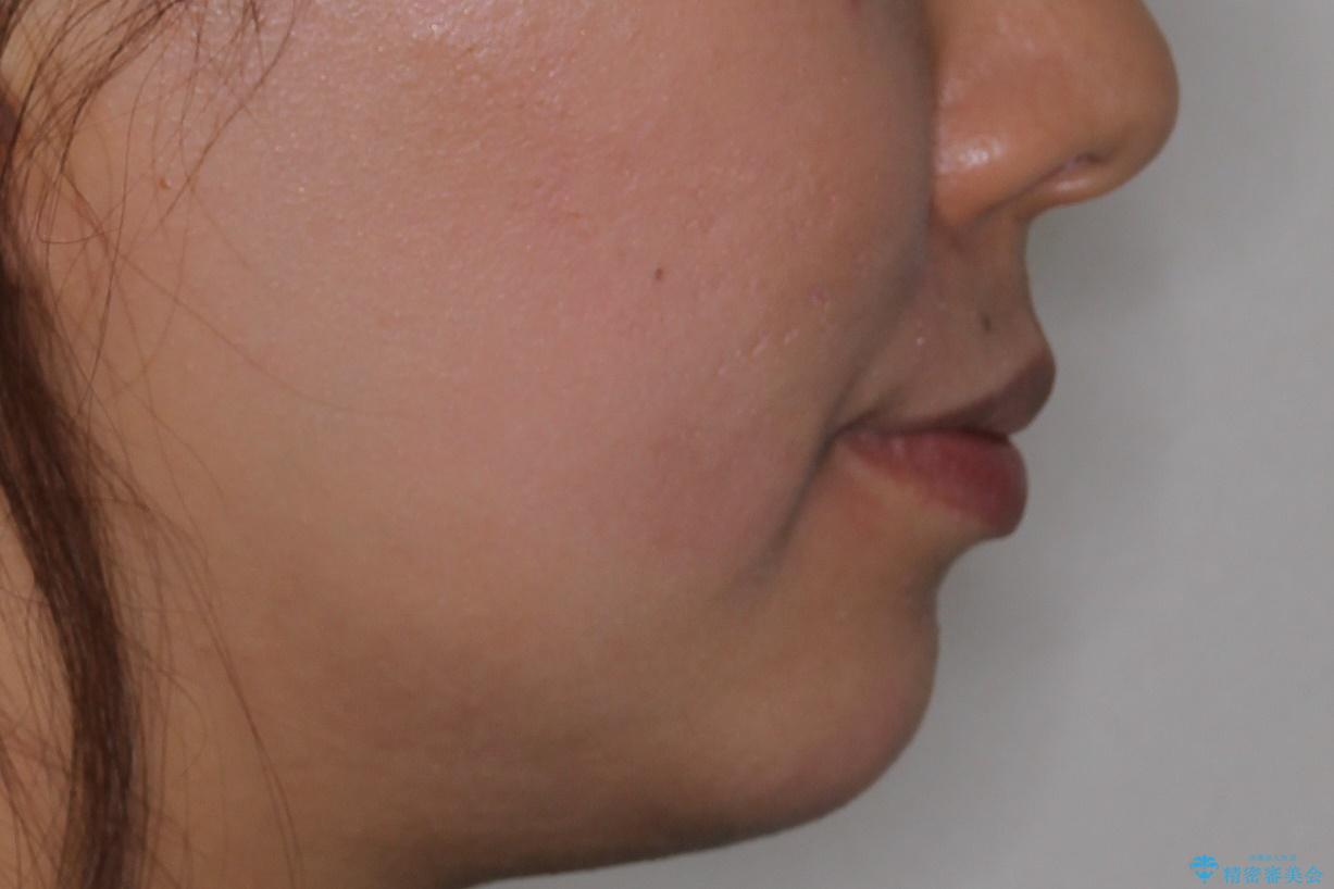 口元が出てるのが気になる 抜歯矯正でしっかりと前歯をさげてすっきりした口元への治療前(顔貌)