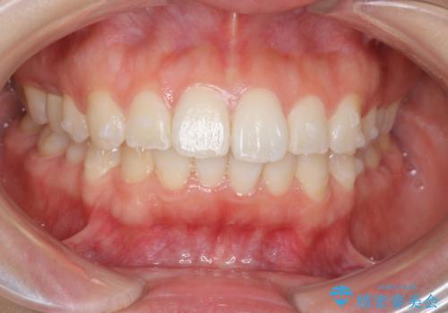 前歯のがたつき インビザラインでの治療中