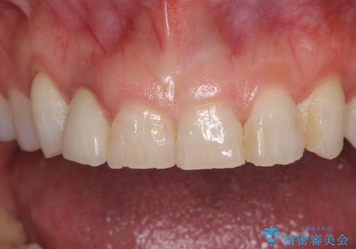 歯肉が腫れている前歯　外科処置を併用したオールセラミッククラウンの治療前