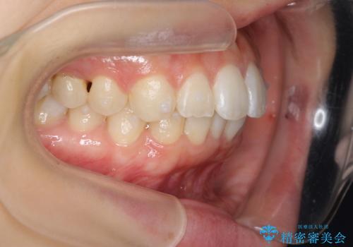 前歯のがたつき インビザラインでの治療中