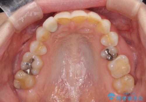 歯肉が腫れている前歯 外科処置を併用したオールセラミッククラウンの治療前