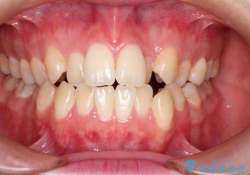 仕事上装置をつけることができない インビザラインで目立たない矯正