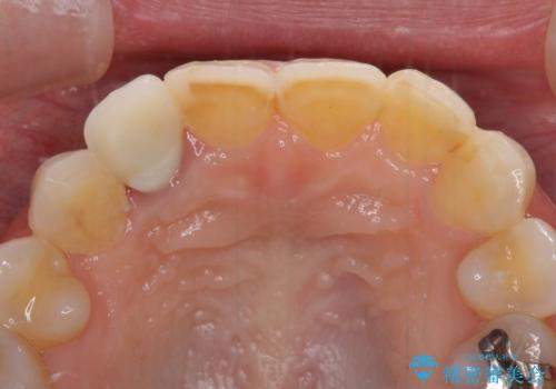 歯肉が腫れている前歯 外科処置を併用したオールセラミッククラウンの治療前