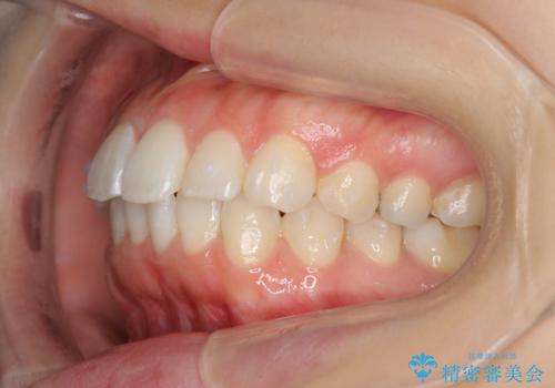 前歯のがたつき インビザラインでの治療中