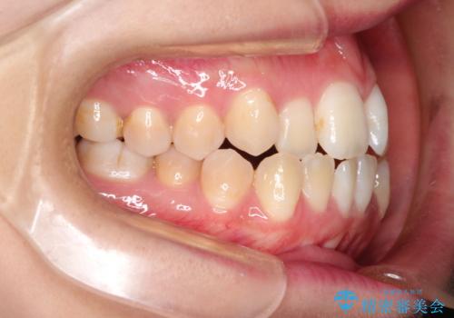 仕事上装置をつけることができない インビザラインで目立たない矯正の治療前