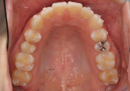 前歯のがたつき インビザラインでの治療中