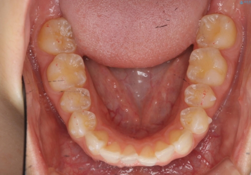 前歯のがたつき インビザラインでの治療中