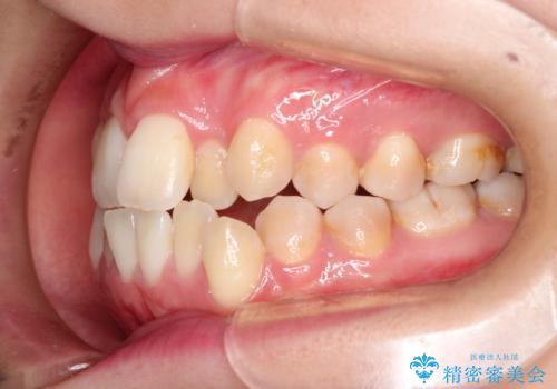 仕事上装置をつけることができない インビザラインで目立たない矯正の治療前