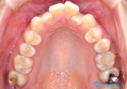 仕事上装置をつけることができない インビザラインで目立たない矯正の治療前