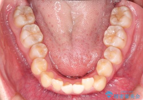 仕事上装置をつけることができない インビザラインで目立たない矯正の治療前