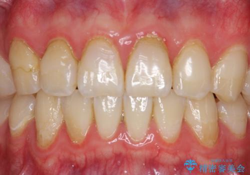 オールセラミッククラウン　色・形が気になる前歯の改善の治療前