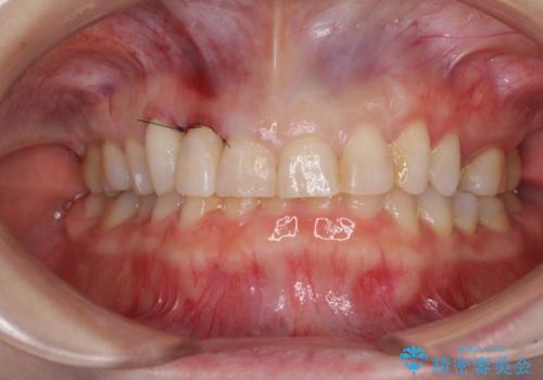 歯肉が腫れている前歯 外科処置を併用したオールセラミッククラウンの治療中