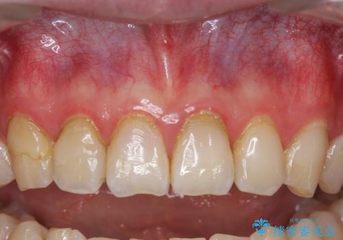 オールセラミッククラウン　色・形が気になる前歯の改善の症例 治療前