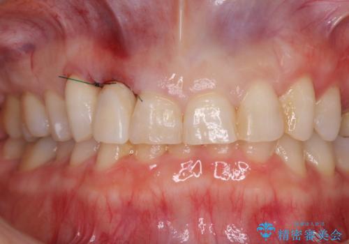 歯肉が腫れている前歯　外科処置を併用したオールセラミッククラウンの治療中