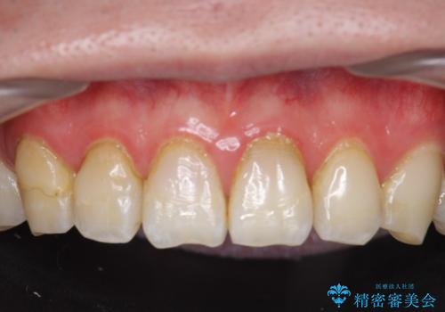 オールセラミッククラウン 色・形が気になる前歯の改善の治療前