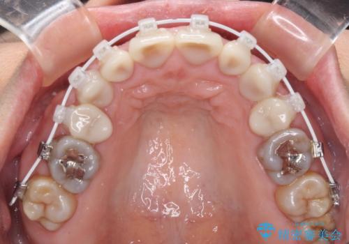 矯正の後戻りと変色歯を治したい　総合歯科診療の治療中