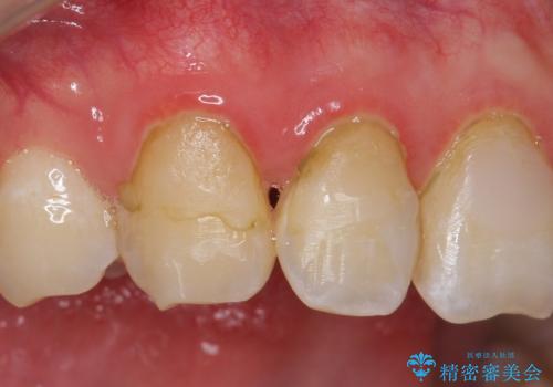 オールセラミッククラウン 色・形が気になる前歯の改善の治療前