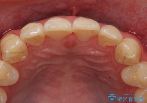 オールセラミッククラウン 色・形が気になる前歯の改善の治療前
