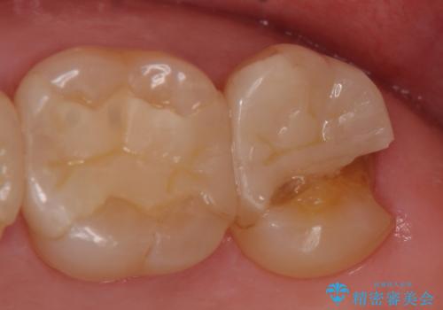 オールセラミッククラウン 欠けた歯の治療