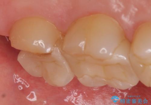 オールセラミッククラウン 欠けた歯の治療の治療前