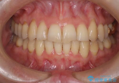 【非抜歯矯正】インビザラインによる矯正の治療後