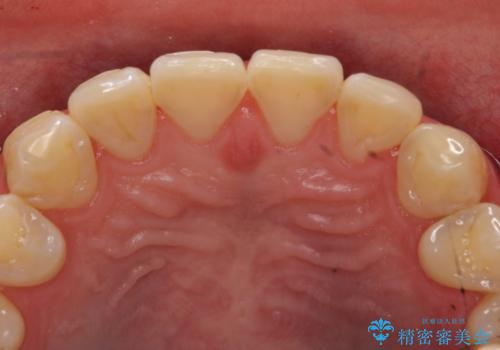 オールセラミッククラウン　色・形が気になる前歯の改善の治療前