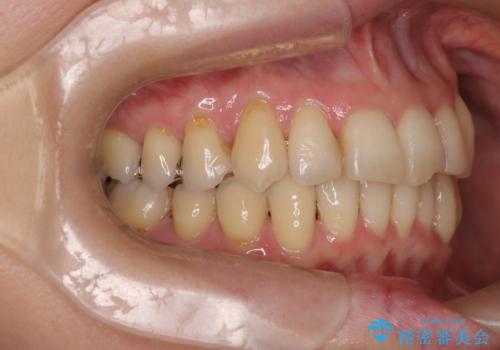 【非抜歯矯正】インビザラインによる矯正の治療後