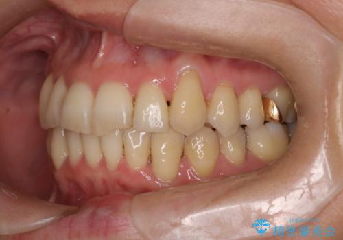 【非抜歯矯正】インビザラインによる矯正の治療後