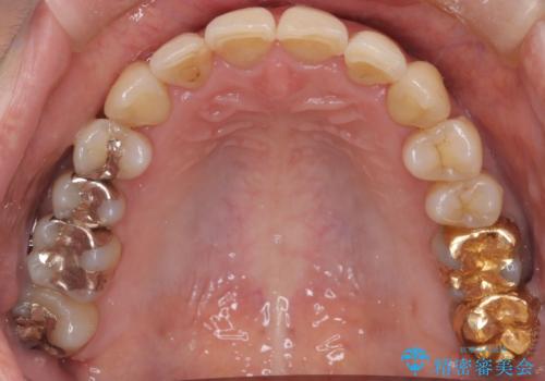【非抜歯矯正】インビザラインによる矯正の治療後