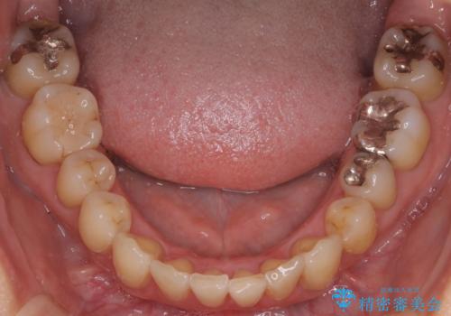 【非抜歯矯正】インビザラインによる矯正の治療後