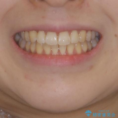 気になるデコボコとオープンバイト インビザラインでの矯正治療の治療後(顔貌)