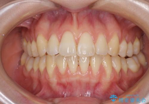 気になるデコボコとオープンバイト インビザラインでの矯正治療の治療中