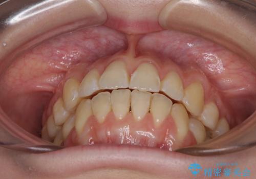 気になるデコボコとオープンバイト インビザラインでの矯正治療の治療中