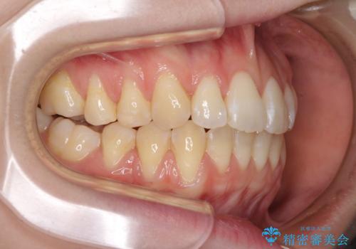 気になるデコボコとオープンバイト インビザラインでの矯正治療の治療中