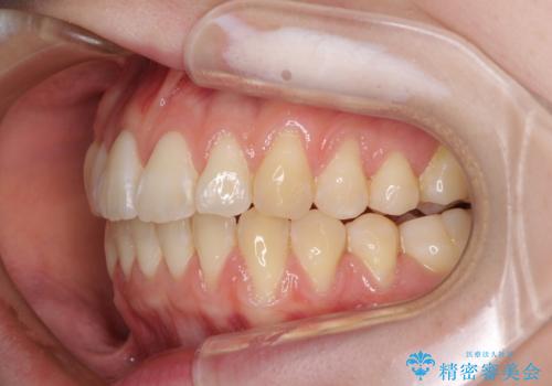 気になるデコボコとオープンバイト インビザラインでの矯正治療の治療中