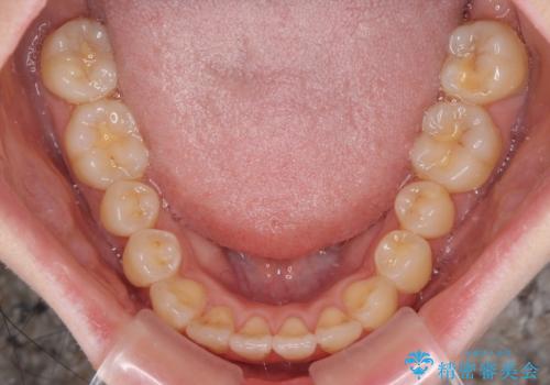 気になるデコボコとオープンバイト インビザラインでの矯正治療の治療中