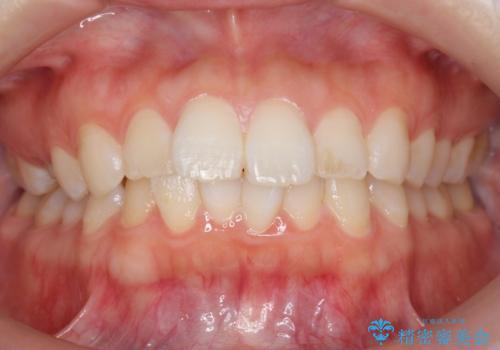 前歯のがたつき インビザラインでの症例 治療前