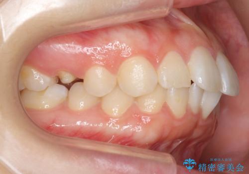 歯の高さがなく、しょっちゅう外れる 他院で治療途中だが病院を変えたい