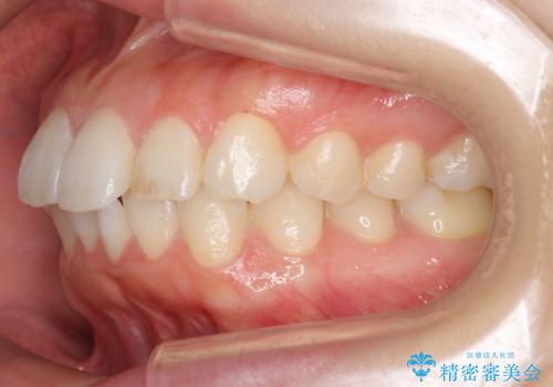 前歯のがたつき インビザラインでの治療前