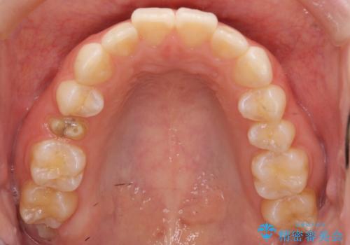 前歯のがたつき インビザラインでの治療前
