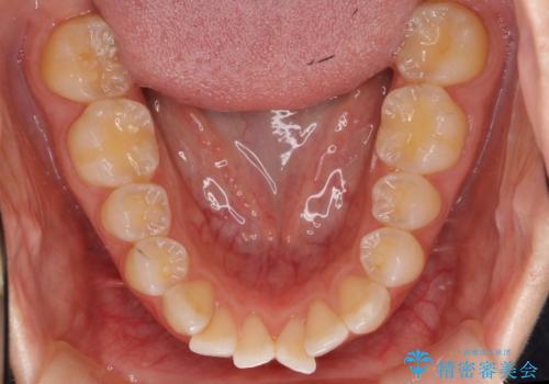 前歯のがたつき インビザラインで