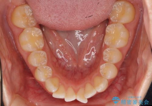 前歯のがたつき　インビザラインでの治療前