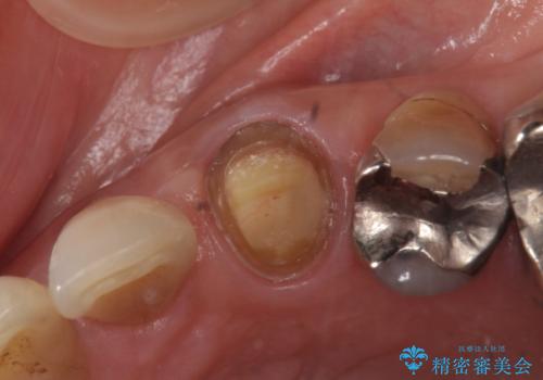 オールセラミッククラウン 再根管治療後の補綴の治療中