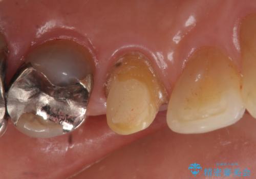 オールセラミッククラウン 再根管治療後の補綴の治療中