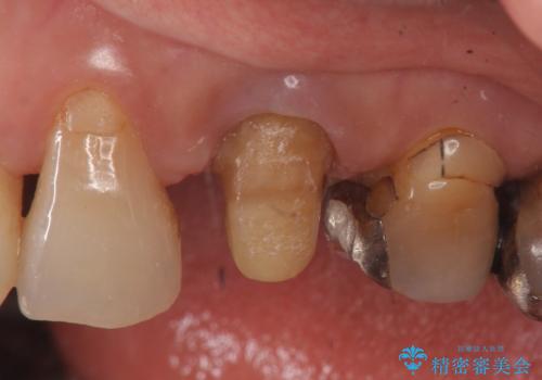 オールセラミッククラウン 再根管治療後の補綴の治療中