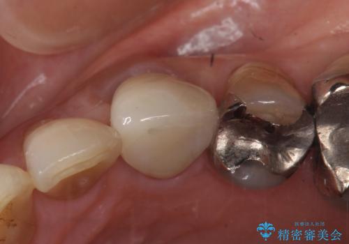 オールセラミッククラウン 再根管治療後の補綴の治療後