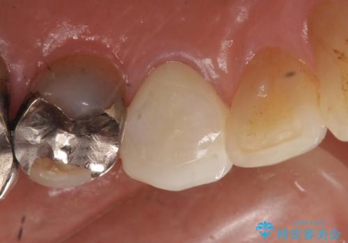 オールセラミッククラウン 再根管治療後の補綴の治療後