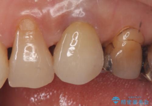 オールセラミッククラウン 再根管治療後の補綴の症例 治療後